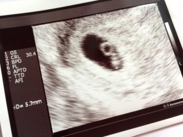 6週4日 胎芽確認